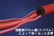 冠動脈のれん縮（スパズム）によって狭くなった血管